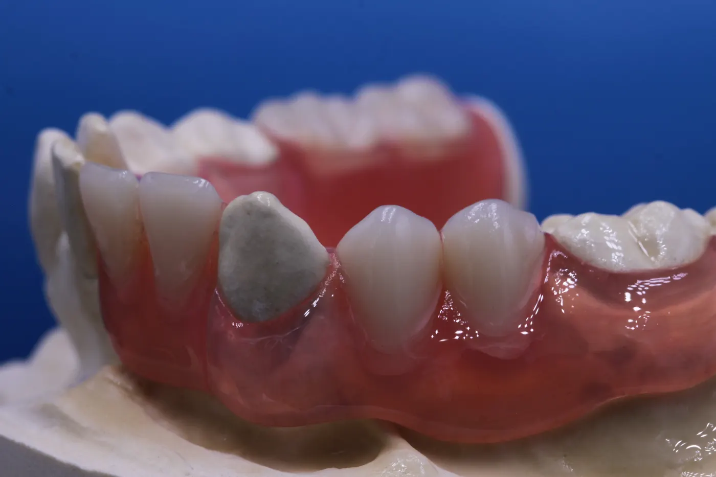 Teilprothese auf dem Modell — Detail der Klammerführung
